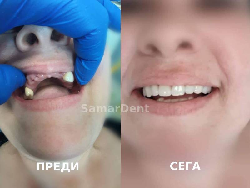Клинични случаи при обеззъбяване